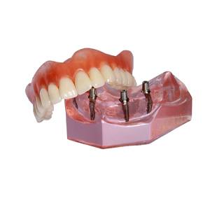 Complete set of full dentures