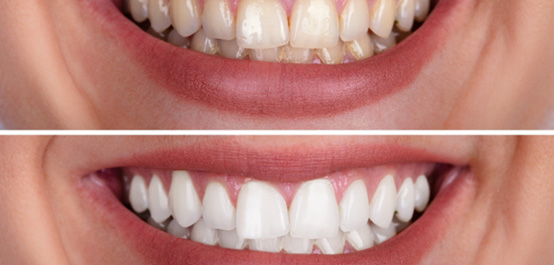 Closeup of someone’s smile showing before/after whitening