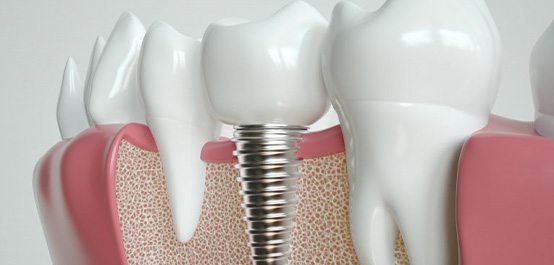 a 3D illustration of a dental implant undergoing osseointegration