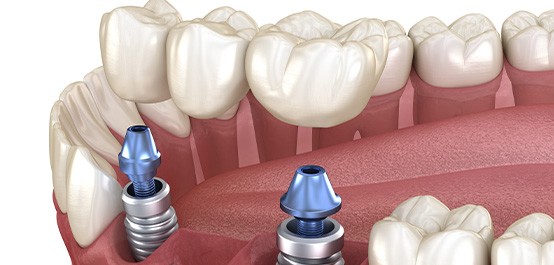 Illustration of implant bridge in lower arch with white background
