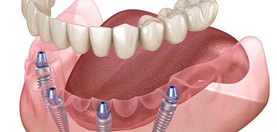 Illustration of implant dentures in lower arch with white background