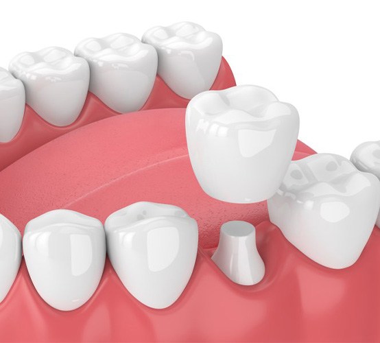 A 3D illustration of a dental crown